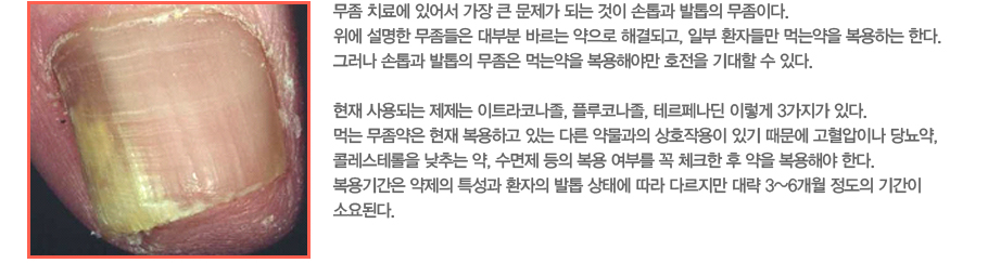 ���� ġ�ῡ �־ ���� ū ������ �Ǵ� ���� ����� ������ �����̴�. ���� ������ �������� ��κ� �ٸ��� ������ �ذ�ǰ�, �Ϻ� ȯ�ڵ鸸 �Դ¾��� �����ϴ� �Ѵ�. �׷��� ����� ������ ������ �Դ¾��� �����ؾ߸� ȣ���� ����� �� �ִ�.
���� ���Ǵ� ������ ��Ʈ���ڳ���, �÷��ڳ���, �׸��䳪�� �̷��� 3������ �ִ�. �Դ� �������� ���� �����ϰ� �ִ� �ٸ� �๰���� ��ȣ�ۿ��� �ֱ� ������ �������̳� �索��, �ݷ����׷��� ���ߴ� ��, ������ ���� ���� ���θ� �� üũ�� �� ���� �����ؾ� �Ѵ�. ����Ⱓ�� ������ Ư���� ȯ���� ���� ���¿� ���� �ٸ����� �뷫 3~6���� ������ �Ⱓ�� �ҿ�ȴ�.