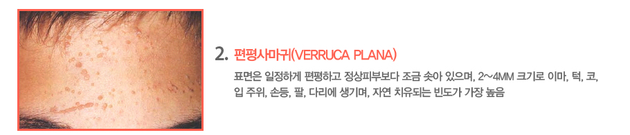 2.����縶��(Verruca Plana)ǥ���� �����ϰ� �����ϰ� �����Ǻκ��� ���� �ھ� ������, 2~4mm ũ��� �̸�, ��, ��, �� ����, �յ�, ��, �ٸ��� �����, �ڿ� ġ���Ǵ� �󵵰� ���� ����