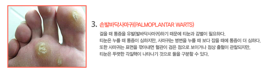 3.�չ߹ٴڻ縶��(Palmoplantar Warts)���� �� ������ ����(�߹ٴڻ縶��)�ϱ� ������ Ƽ���� ������ �ʿ��ϴ�. Ƽ���� ���� �� ������ ��������, �縶�ʹ� ������ ���� �� ���� ���� ���� ������ �� ���ϴ�.  ���� �縶�ʹ� ǥ���� ��Ƴ��� ������ ���� ������ ���̰ų� ���� ������ ����������, Ƽ���� �ѷ��� �������� ��Ÿ���� ������ ���� ������ �� �ִ�.