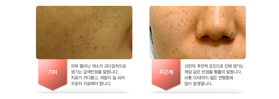 [���]�Ǻ� ���� ������ ����ħ������ ����� ���������� ���մϴ�. ġ�ᰡ ��ٷӰ�, ����� �� �Ǿ� ������ ġ���ؾ� �մϴ�.[�ֱٱ�]��õ��, ��õ�� �������� ���� ����� ���� ���� ������ ��Ʋ�� ���մϴ�. ���� 20����� ���� �������� ���� �߻��˴ϴ�.