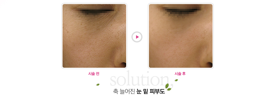 �� �þ��� �� �� �Ǻε�