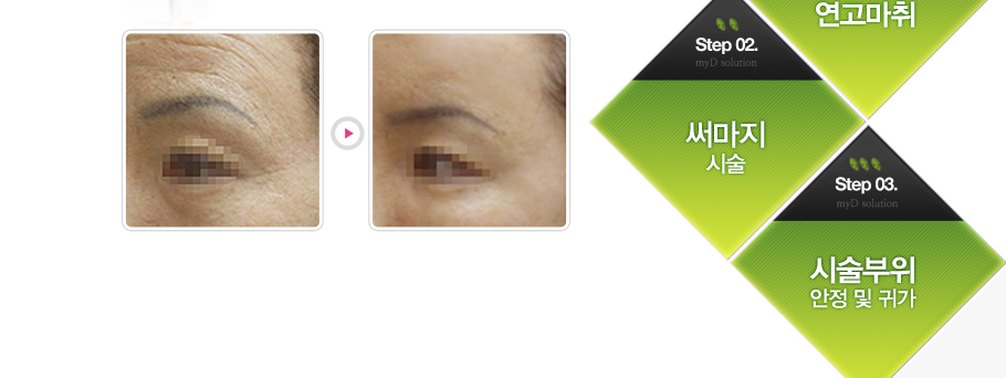 Step 01.Ŭ��¡ �� ��������
Step 02.�Ḷ�� �ü�
Step 03.�ü����� ���� �� �Ͱ�